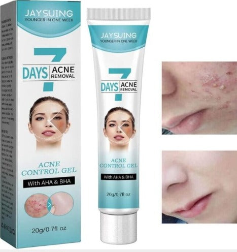 Crema tratamiento acne mascarilla facial